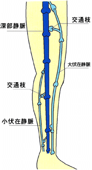 下肢静脈瘤の原因