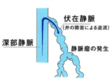 下肢静脈瘤の原因