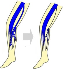 下肢静脈瘤治療法その1