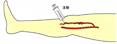 硬化療法